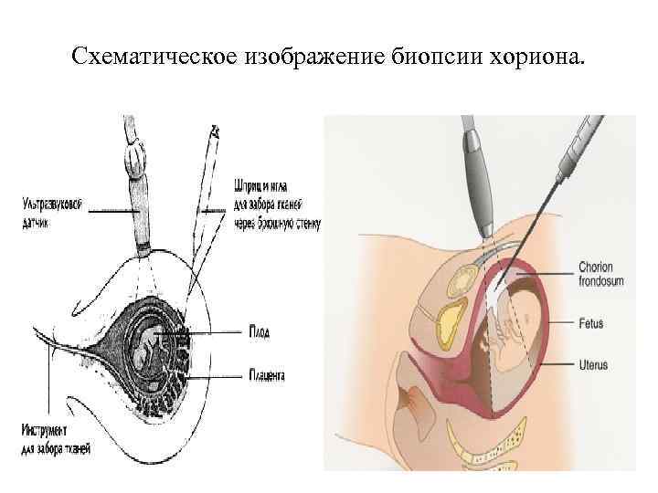 Схематическое изображение биопсии хориона.  