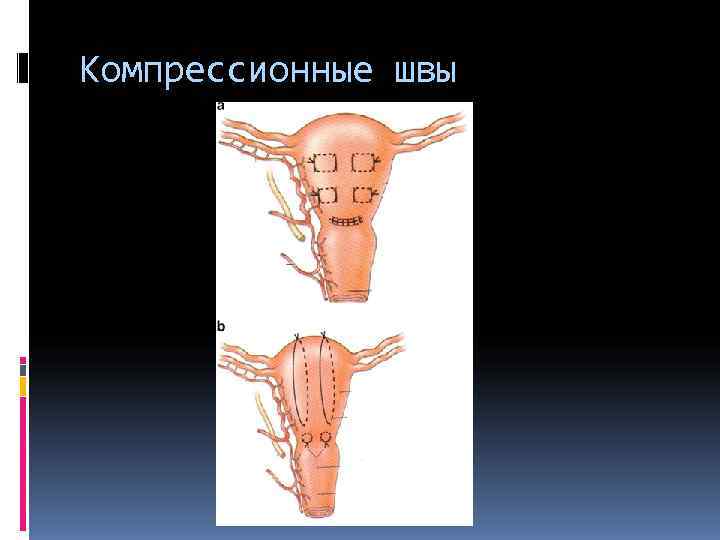 Компрессионные швы 