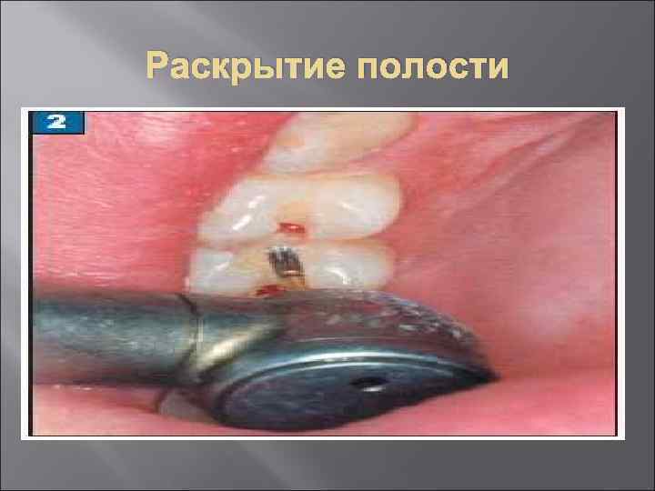 Раскрытие полости 