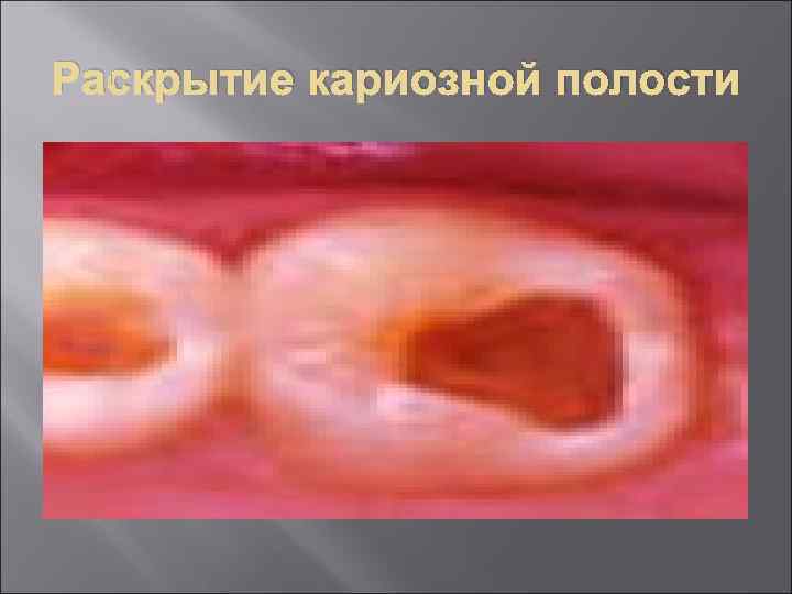 Раскрытие кариозной полости 