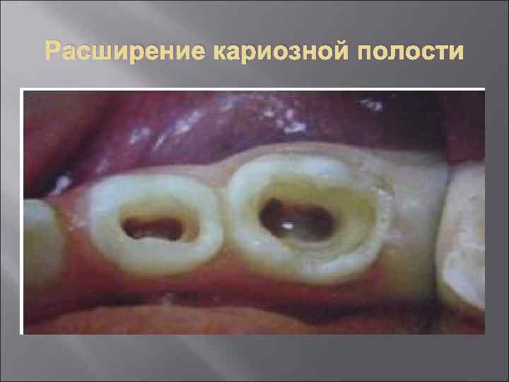 Расширение кариозной полости 