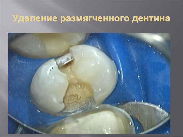 Удаление размягченного дентина 