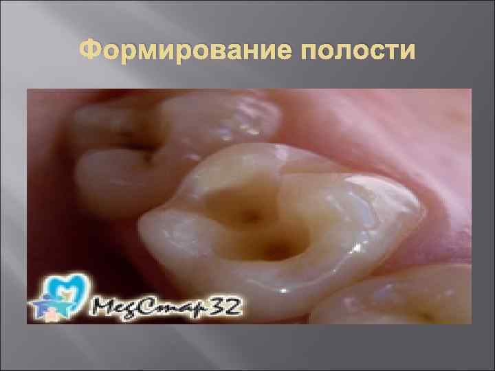 Формирование полости 