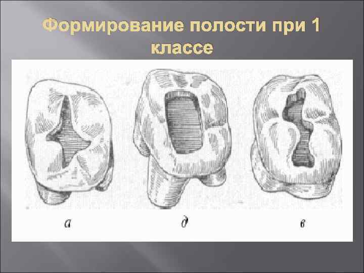 3 класс кариозной полости