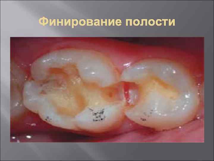 Финирование полости 