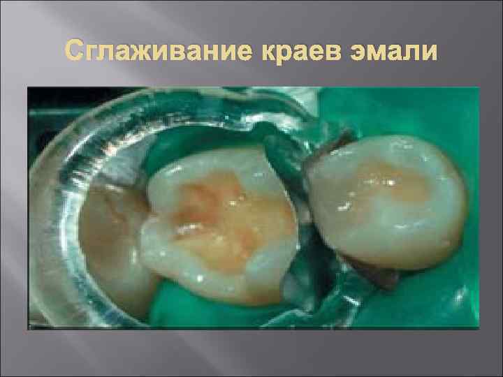 Сглаживание краев эмали 