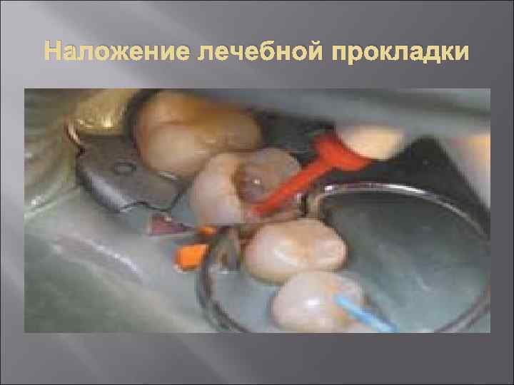 Наложение лечебной прокладки 