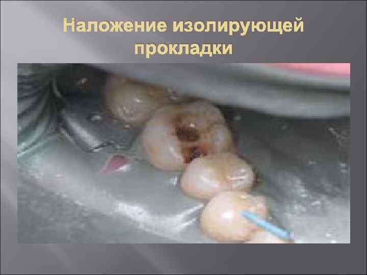 Наложение изолирующей  прокладки 