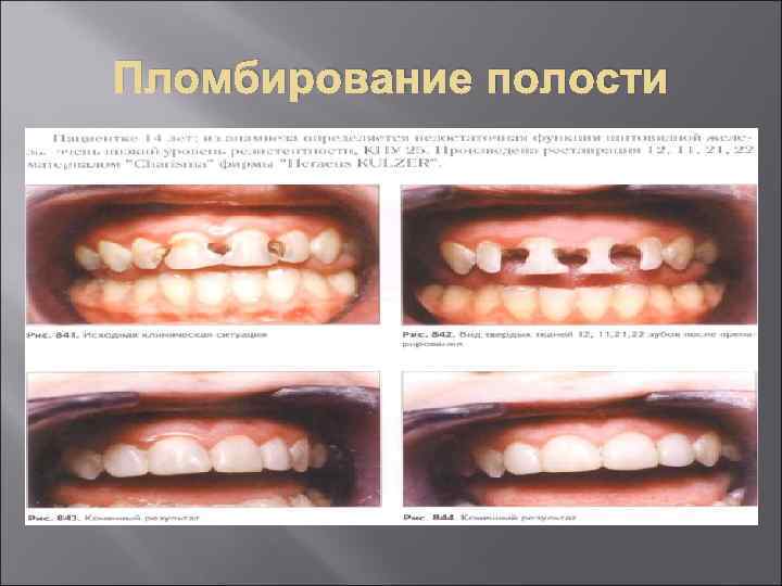 Пломбирование полости 