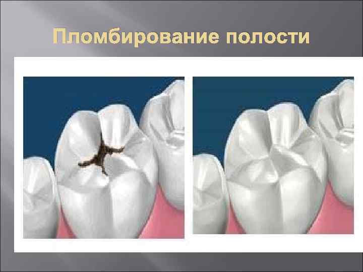 Пломбирование полости. Пломбирование полостей 1-5 классов по Блэку. Этапы пломбирования кариозных полостей. Кариозные полости 1 класса по Блэку методика пломбирования. Пломбирование полости первого класса по Блеку.