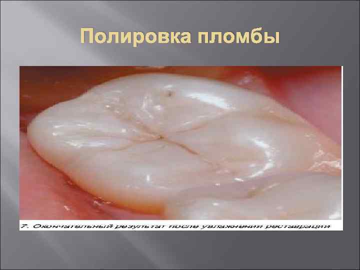 Полировка пломбы 