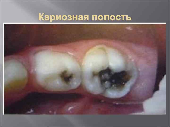 Кариозная полость 