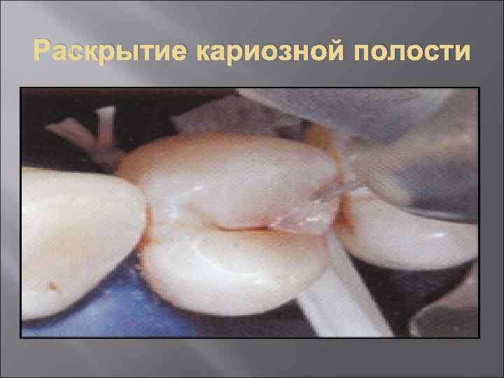 Раскрытие кариозной полости 