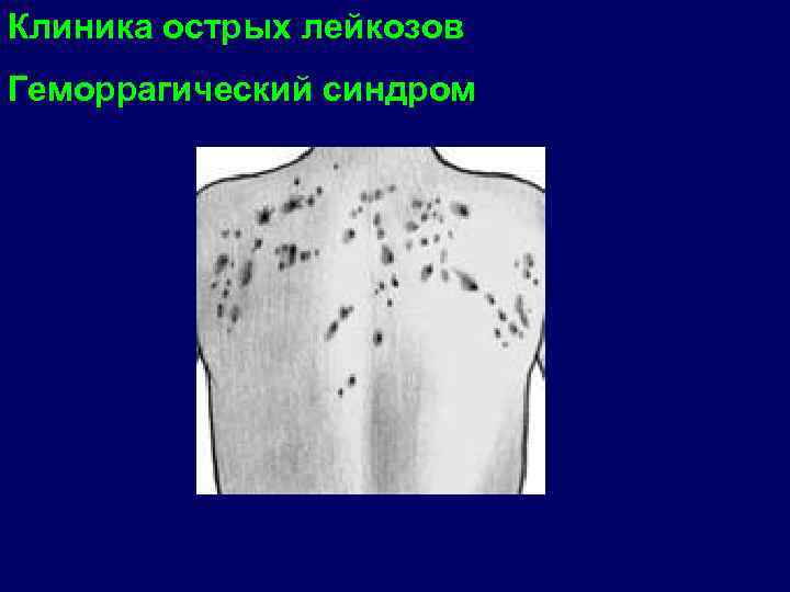 Клиника острых лейкозов Геморрагический синдром 