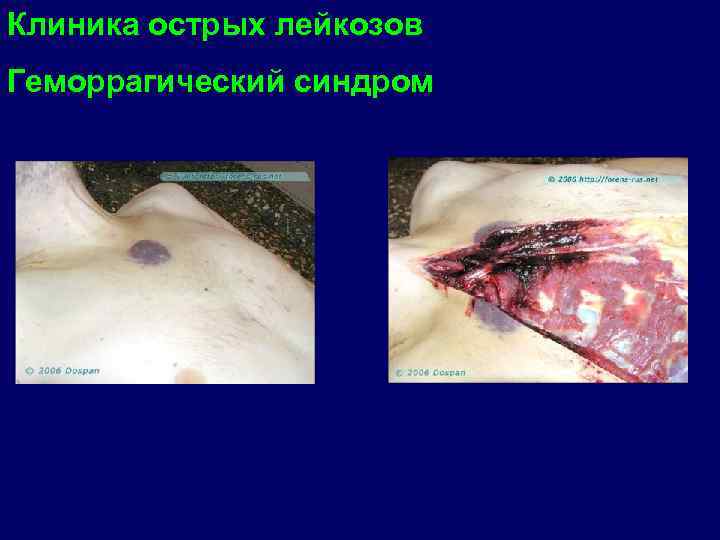 Клиника острых лейкозов Геморрагический синдром 