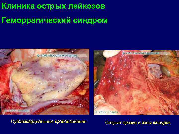 Клиника острых лейкозов Геморрагический синдром  Субэпикардиальные кровоизлияния  Острые эрозия и язвы желудка
