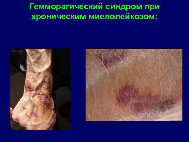 Гемморагический синдром при хроническим миелолейкозом: 