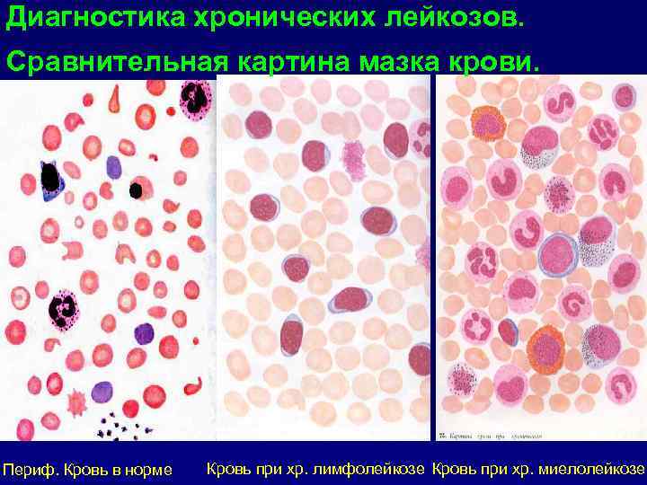 Моноцитарный лейкоз картина крови