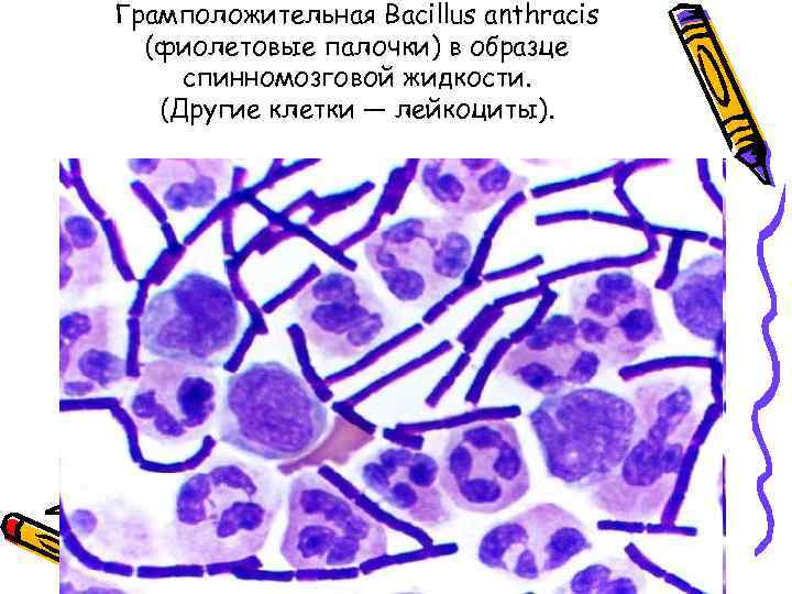 Грамположительная Bacillus anthracis  (фиолетовые палочки) в образце cпинномозговой жидкости. (Другие клетки — лейкоциты).