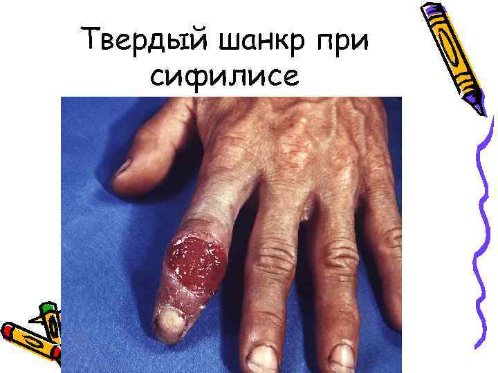 Твердый шанкр при сифилисе 