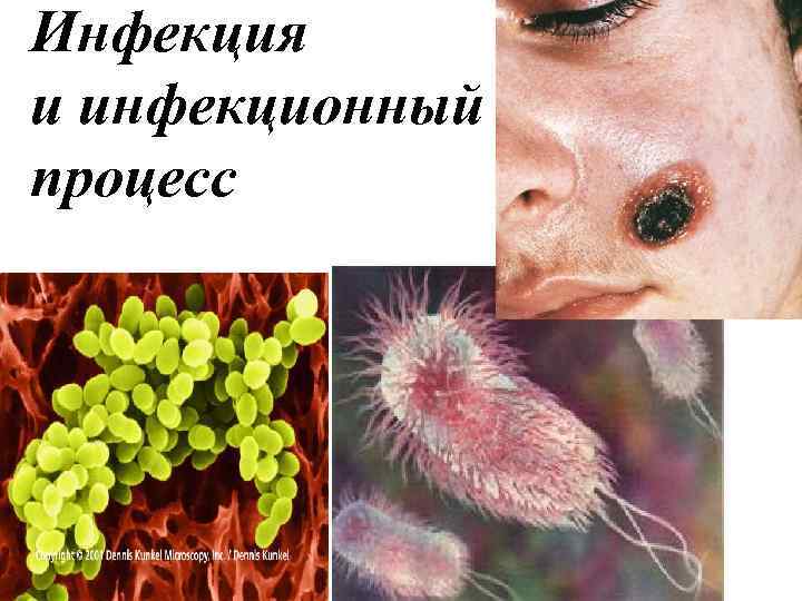 Инфекция и инфекционный процесс Инфекция и инфекционный процесс