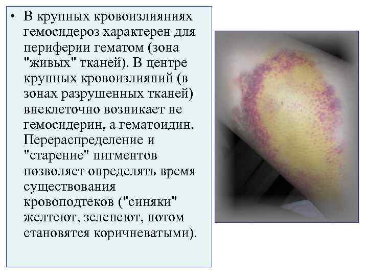  • В крупных кровоизлияниях  гемосидероз характерен для  периферии гематом (зона 