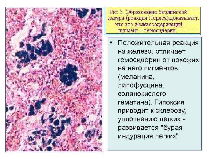  • Положительная реакция  на железо, отличает  гемосидерин от похожих  на