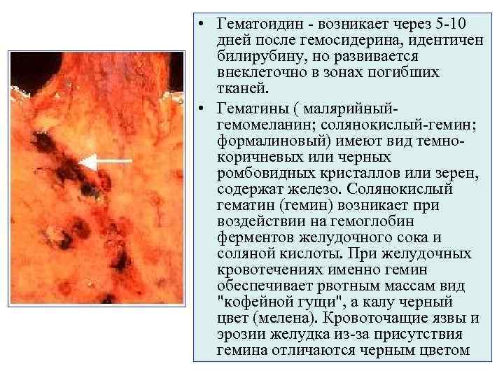  • Гематоидин - возникает через 5 -10  дней после гемосидерина, идентичен 