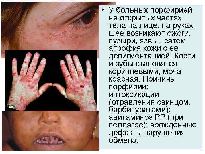  • У больных порфирией  на открытых частях  тела на лице, на