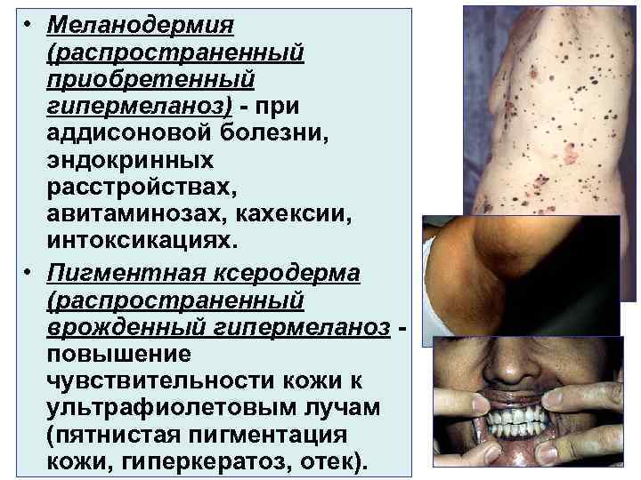  • Меланодермия  (распространенный  приобретенный  гипермеланоз) - при  аддисоновой болезни,