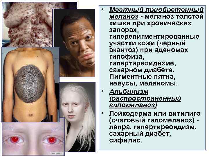  • Местный приобретенный  меланоз - меланоз толстой  кишки при хронических 