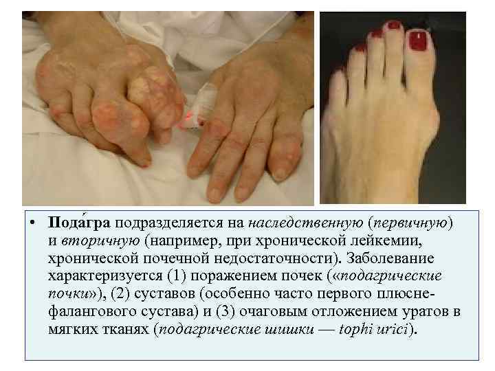  • Пода гра подразделяется на наследственную (первичную)  и вторичную (например, при хронической