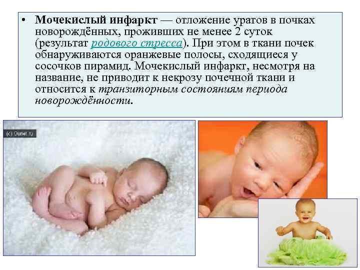  • Мочекислый инфаркт — отложение уратов в почках  новорождённых, проживших не менее