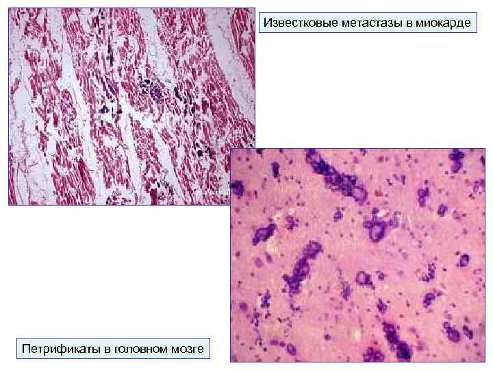       Известковые метастазы в миокарде Петрификаты в головном мозге