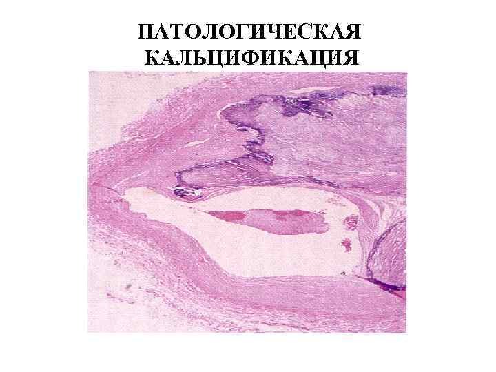 ПАТОЛОГИЧЕСКАЯ КАЛЬЦИФИКАЦИЯ 