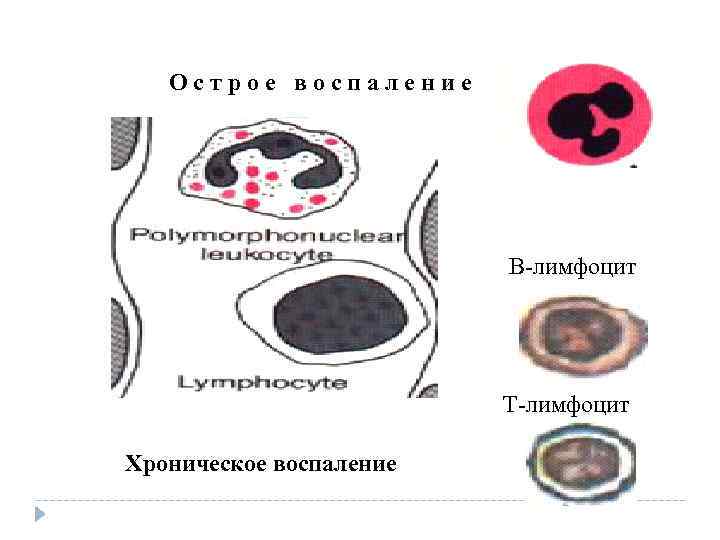 Острое воспаление В-лимфоцит Т-лимфоцит Острое воспаление В-лимфоцит Т-лимфоцит