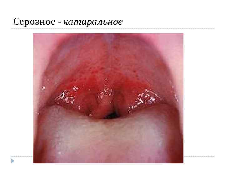 Серозное - катаральное Серозное - катаральное