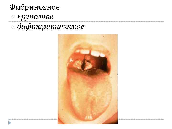 Фибринозное - крупозное - дифтеритическое Фибринозное - крупозное - дифтеритическое