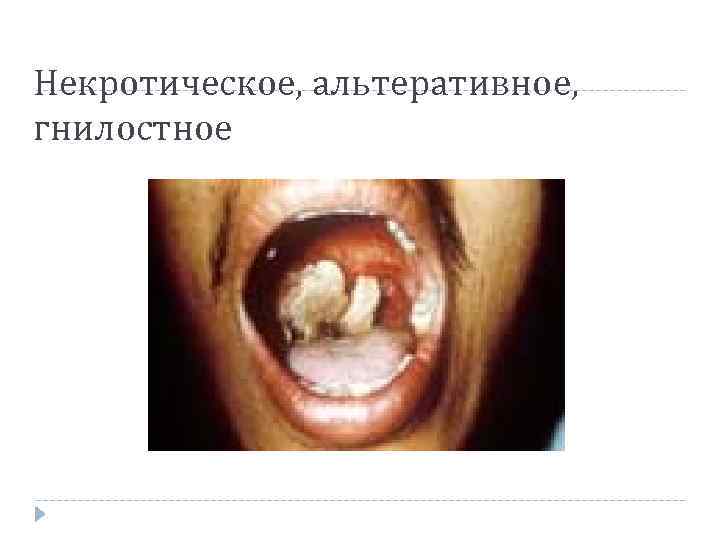 Некротическое, альтеративное, гнилостное Некротическое, альтеративное, гнилостное