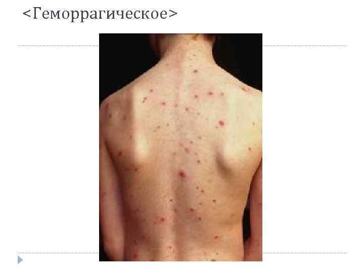 <Геморрагическое> <Геморрагическое>