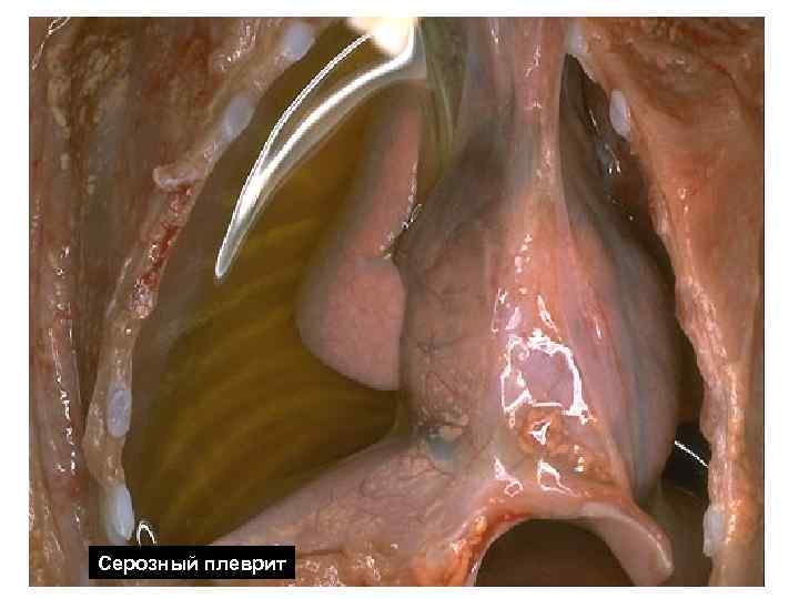 Серозный плеврит Серозный плеврит