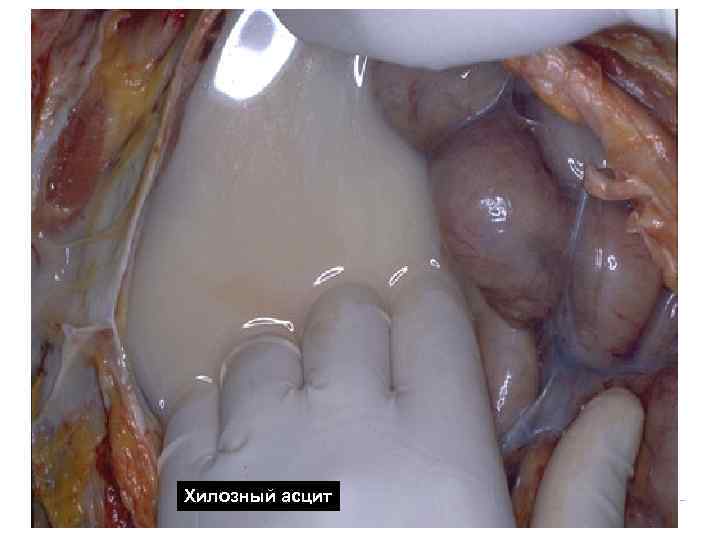 Хилозный асцит Хилозный асцит