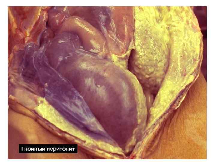 Гнойный перитонит Гнойный перитонит