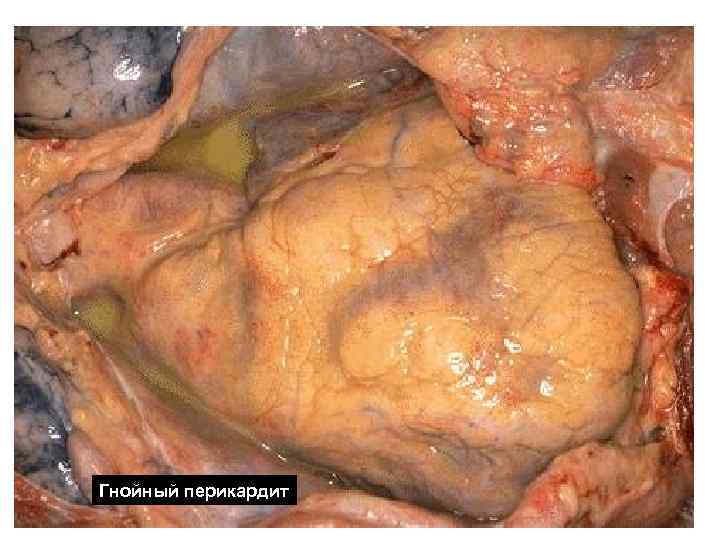 Гнойный перикардит Гнойный перикардит