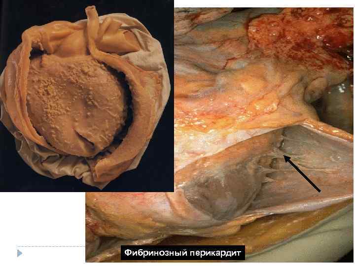Фибринозный перикардит Фибринозный перикардит