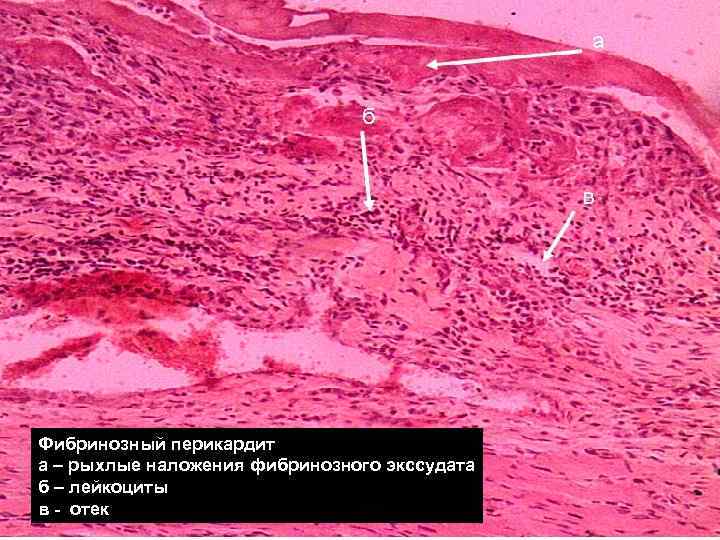 Фибринозный перикардит а – рыхлые наложения фибринозного экссудата б – лейкоциты в - отек Фибринозный перикардит а – рыхлые наложения фибринозного экссудата б – лейкоциты в - отек