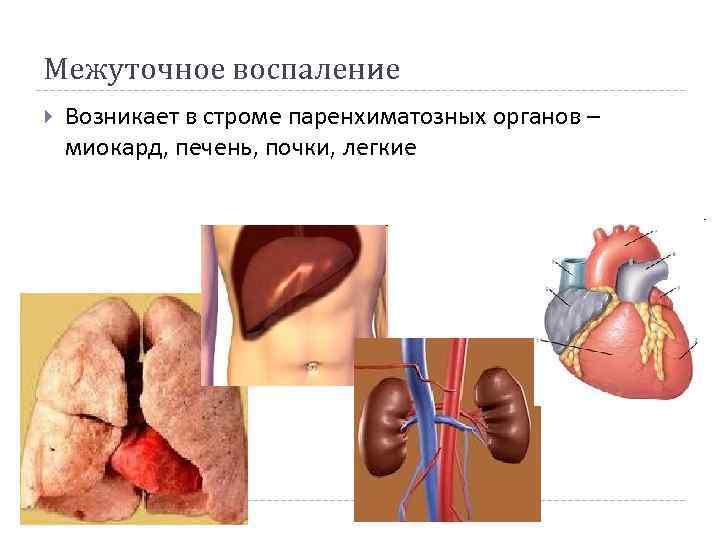 Межуточное воспаление Возникает в строме паренхиматозных органов – миокард, печень, почки, легкие Межуточное воспаление Возникает в строме паренхиматозных органов – миокард, печень, почки, легкие
