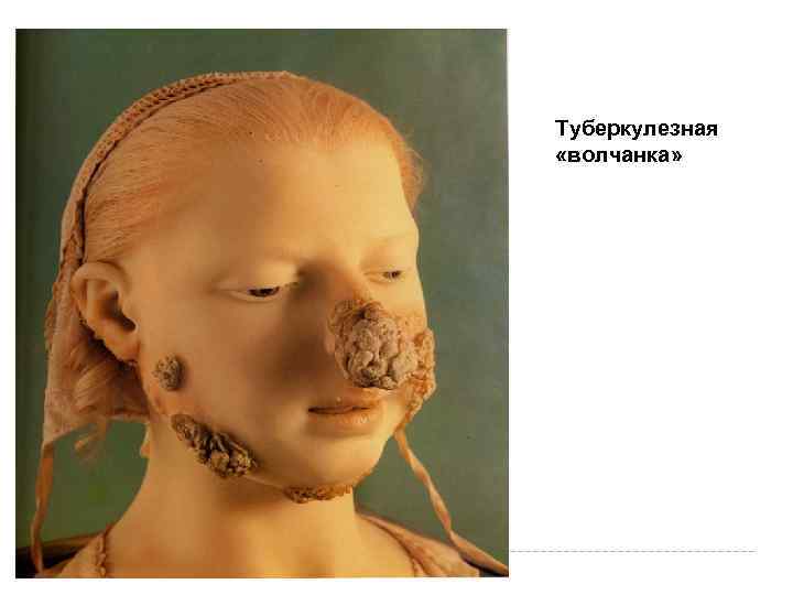 Туберкулезная «волчанка» Туберкулезная «волчанка»