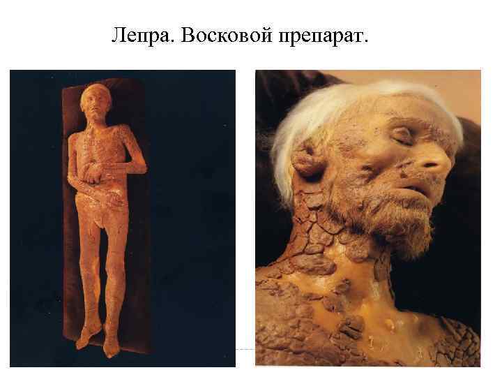 Лепра. Восковой препарат. Лепра. Восковой препарат.