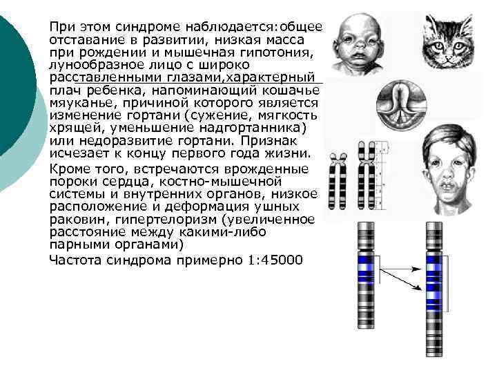   При этом синдроме наблюдается: общее отставание в развитии, низкая масса при рождении